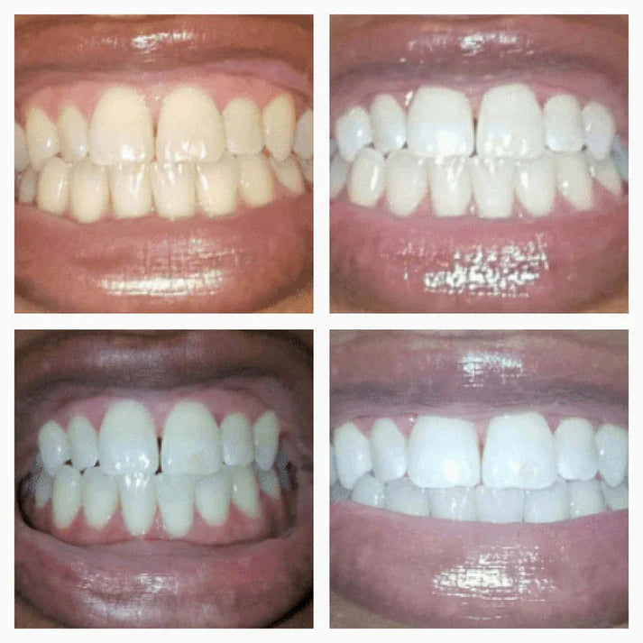 SmileFitPro™ Teeth Whitening Pen