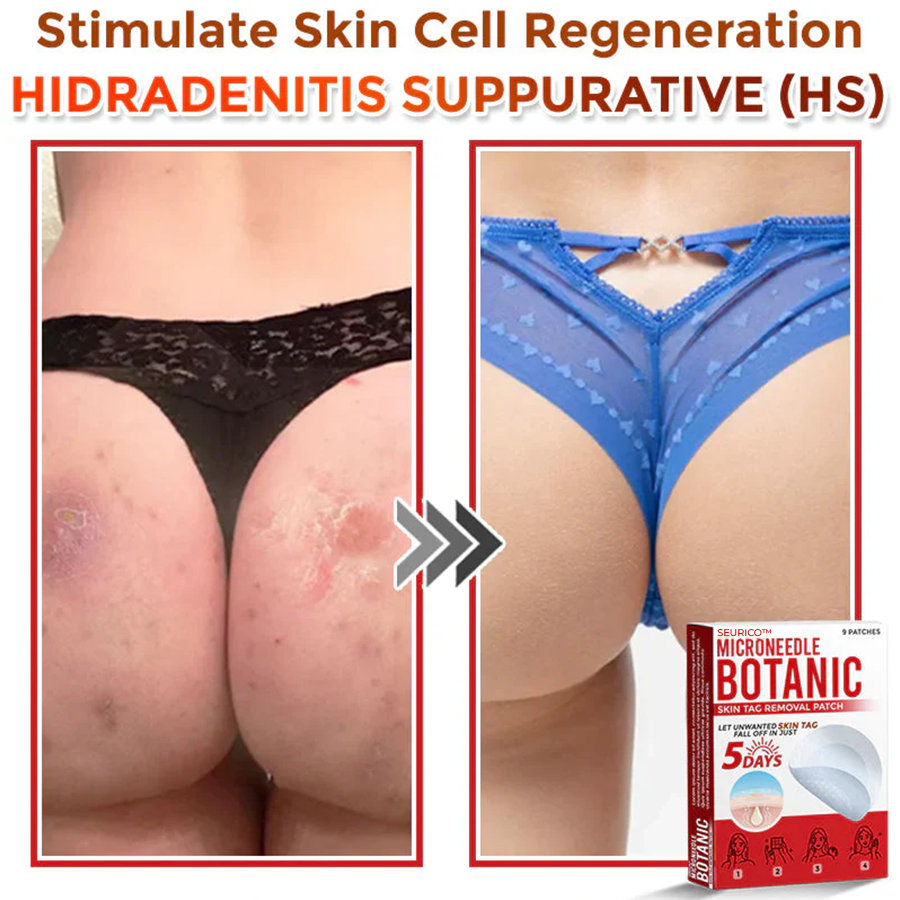 Seurico™ MicroNeedle Botanic Skin Tag Removal Patch