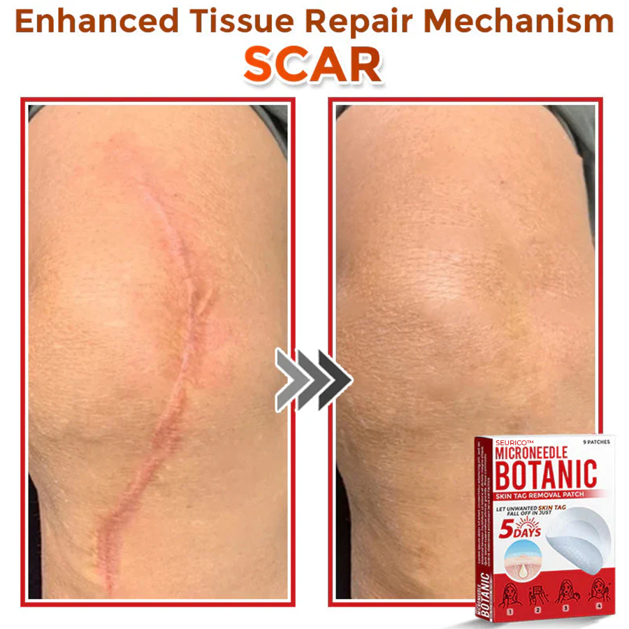 Seurico™ MicroNeedle Botanic Skin Tag Removal Patch