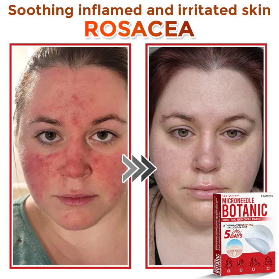 Seurico™ MicroNeedle Botanic Skin Tag Removal Patch