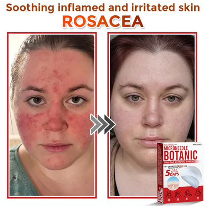 Seurico™ MicroNeedle Botanic Skin Tag Removal Patch