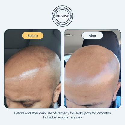 NEGUSY for Dark Spots - All-in-One Nightly Serum for Fading Dark Spots & Evening Skin Tone with Retinol, Kojic Acid & Tranexamic Acid