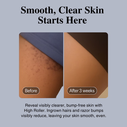 High Roller Ingrown Tonic - Serum for Eliminating Ingrown Hairs and Razor Bumps