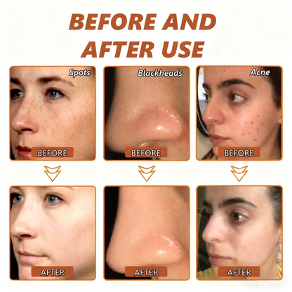 Whitening and Spot-Removing Face Mask Suitable for face and body – 👩‍⚕️ Natural ingredients permanently remove age spots, freckles, sun spots, and liver spots.