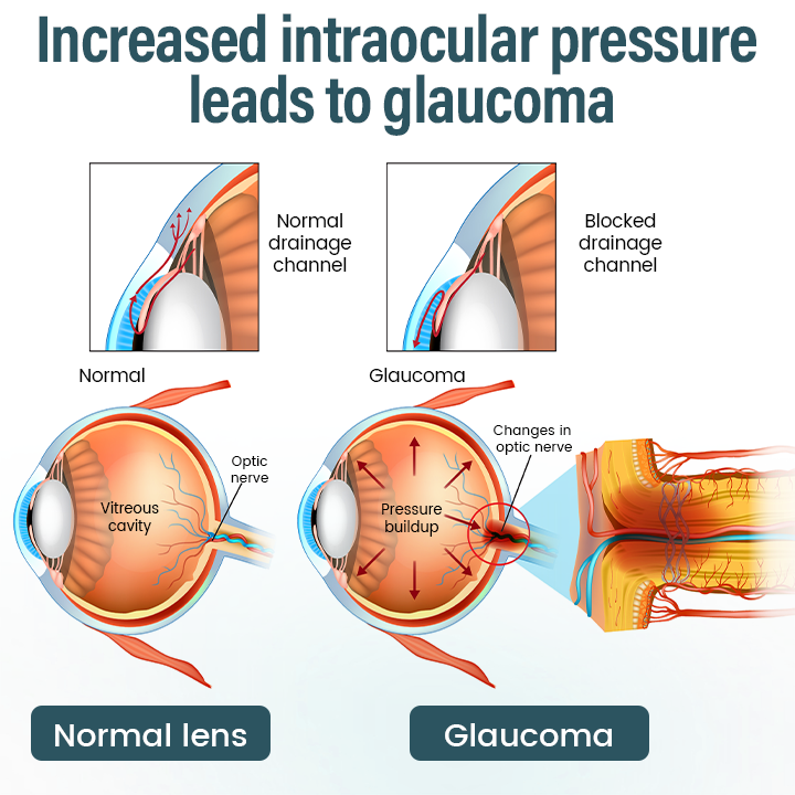 𝗧𝗶𝗺𝗹𝗹𝗸® OptiFusion Nano Eye Drops Serum - Nano-Technology Eye Drops for Root Cause Vision Repair