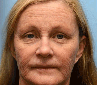 🌟👨‍⚕️Made and shipped from Australia 💫Rolimey® Botox & Vita-A Retinol Shot Wrinkle-Lift Tightening cream - Last Day Promotion 70% OFF